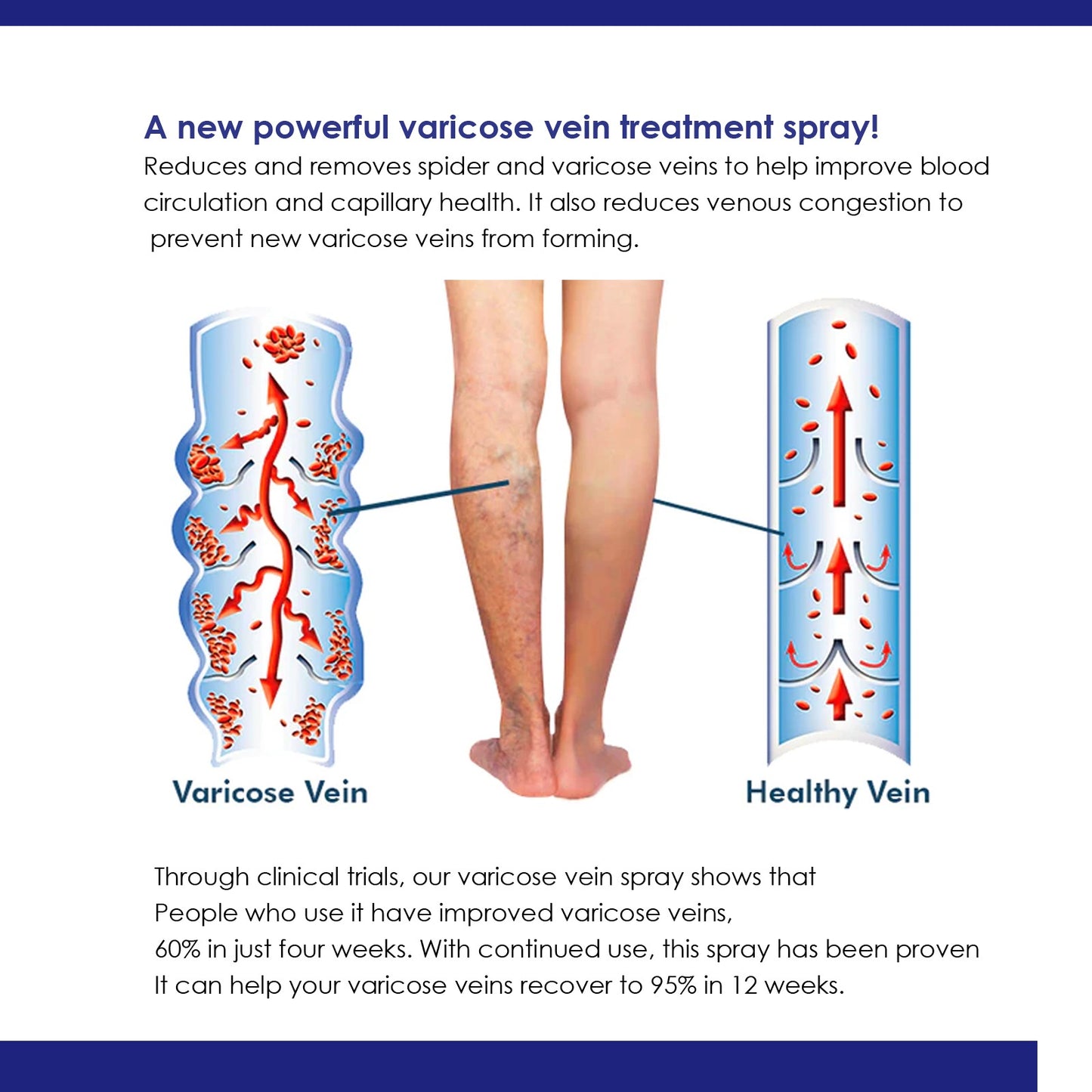 OUHOE® Varicose Vein Spray