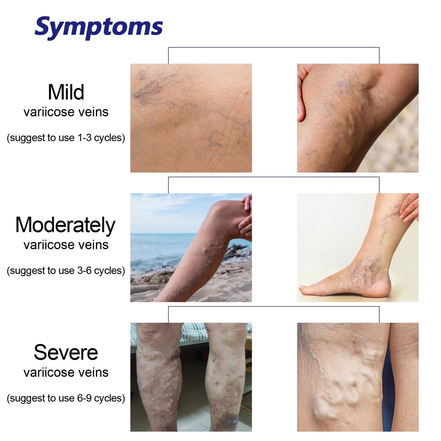 OUHOE® Varicose Vein Spray