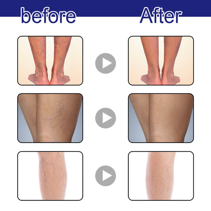 OUHOE® Varicose Vein Spray